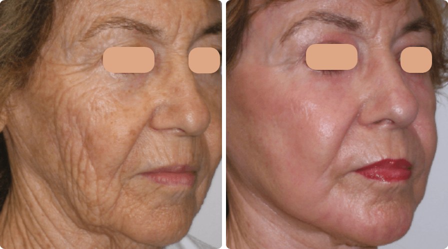Facial wrinkles & texture visibly smoothed after CO₂ resurfacing. Representative manufacturer clinical image (Lumenis UltraPulse®) — individual results vary.