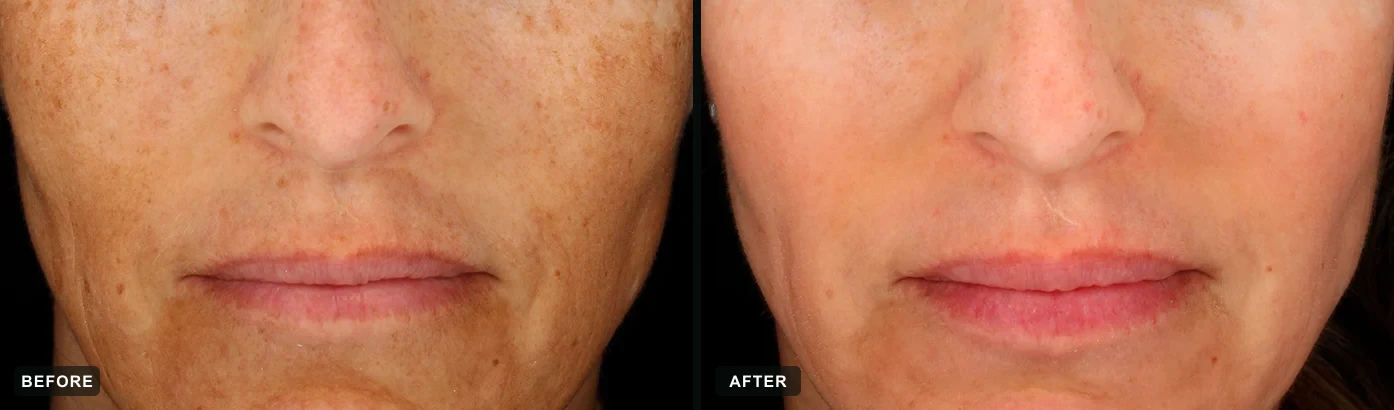 Severe melasma and diffuse sun damage visibly corrected after a cosmelan® depigmentation protocol. Representative manufacturer clinical case courtesy of mesoestetic®. Individual results vary.