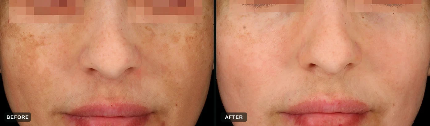 Melasma in the classic “mask” pattern markedly cleared after a cosmelan® protocol. Representative manufacturer clinical case courtesy of mesoestetic®. Individual results vary.