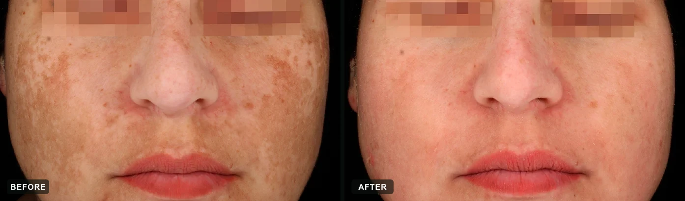 Melasma and sun-induced pigmentation visibly improved after a cosmelan® protocol. Representative manufacturer clinical case courtesy of mesoestetic®. Individual results vary.