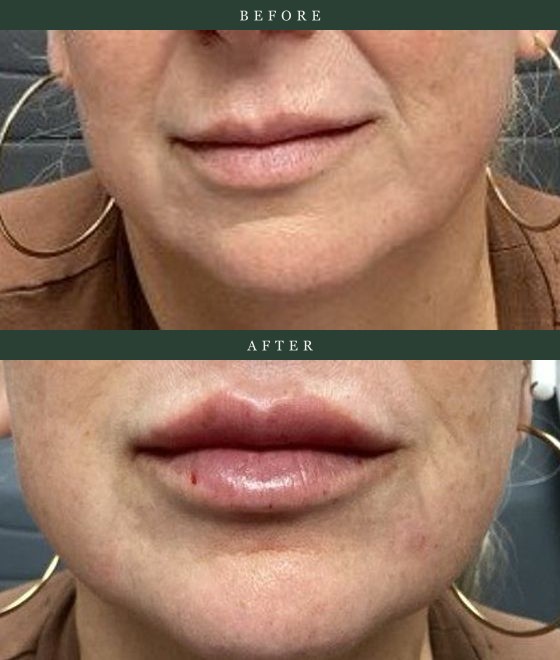 Lip filler — added fullness and definition in balance with the lower face. Actual Juniper Dermatology patient; individual results vary.