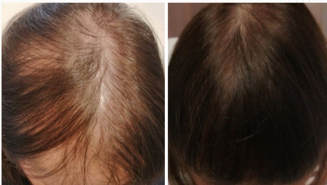 Folix laser hair regrowth before and after - Thinning crown - after 5 Folix® sessions