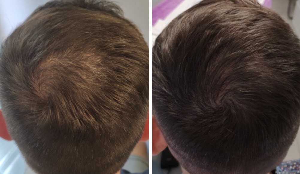 Folix laser hair regrowth before and after - Crown thinning - after 3 Folix® sessions