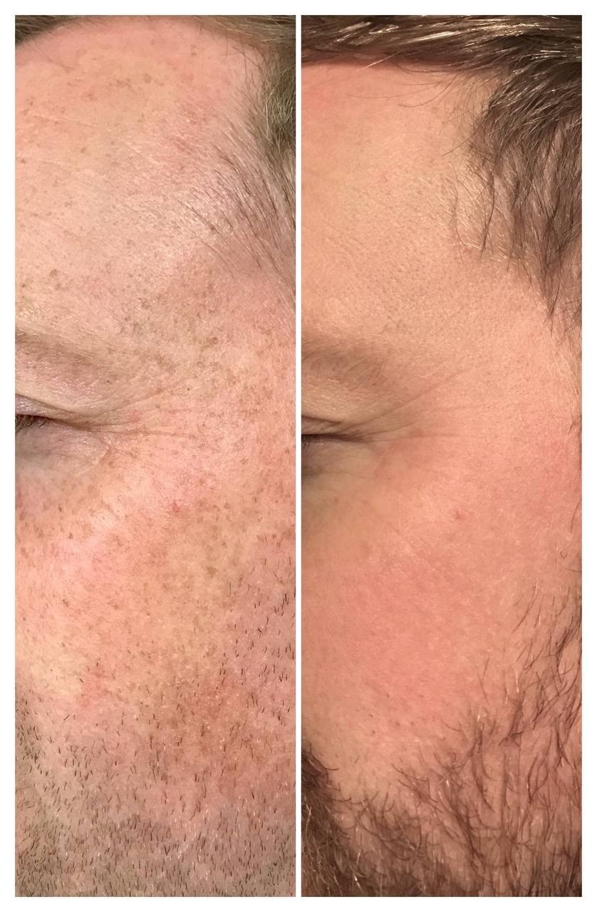 Sun spots & brown patches lifted for a clearer, more even complexion after IPL. Representative manufacturer clinical image (LUVO Lucent™) — individual results vary.