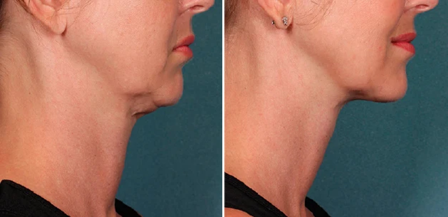 Under-chin fullness reduced for a cleaner jaw-to-neck profile after a Kybella® series. Representative manufacturer clinical image (Kybella®, Allergan) — individual results vary.