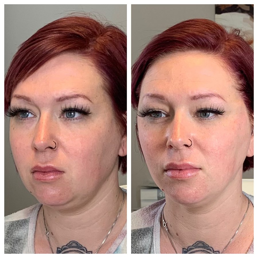Jawline & jowls lifted and redefined after a PDO thread lift. Representative manufacturer clinical image (Les Encres® PDO threads) — individual results vary.