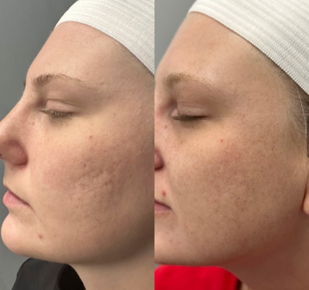 Acne scarring & skin texture visibly refined after RF microneedling. Representative manufacturer clinical image (Pixel8-RF™, courtesy Rohrer Aesthetics) — individual results vary.