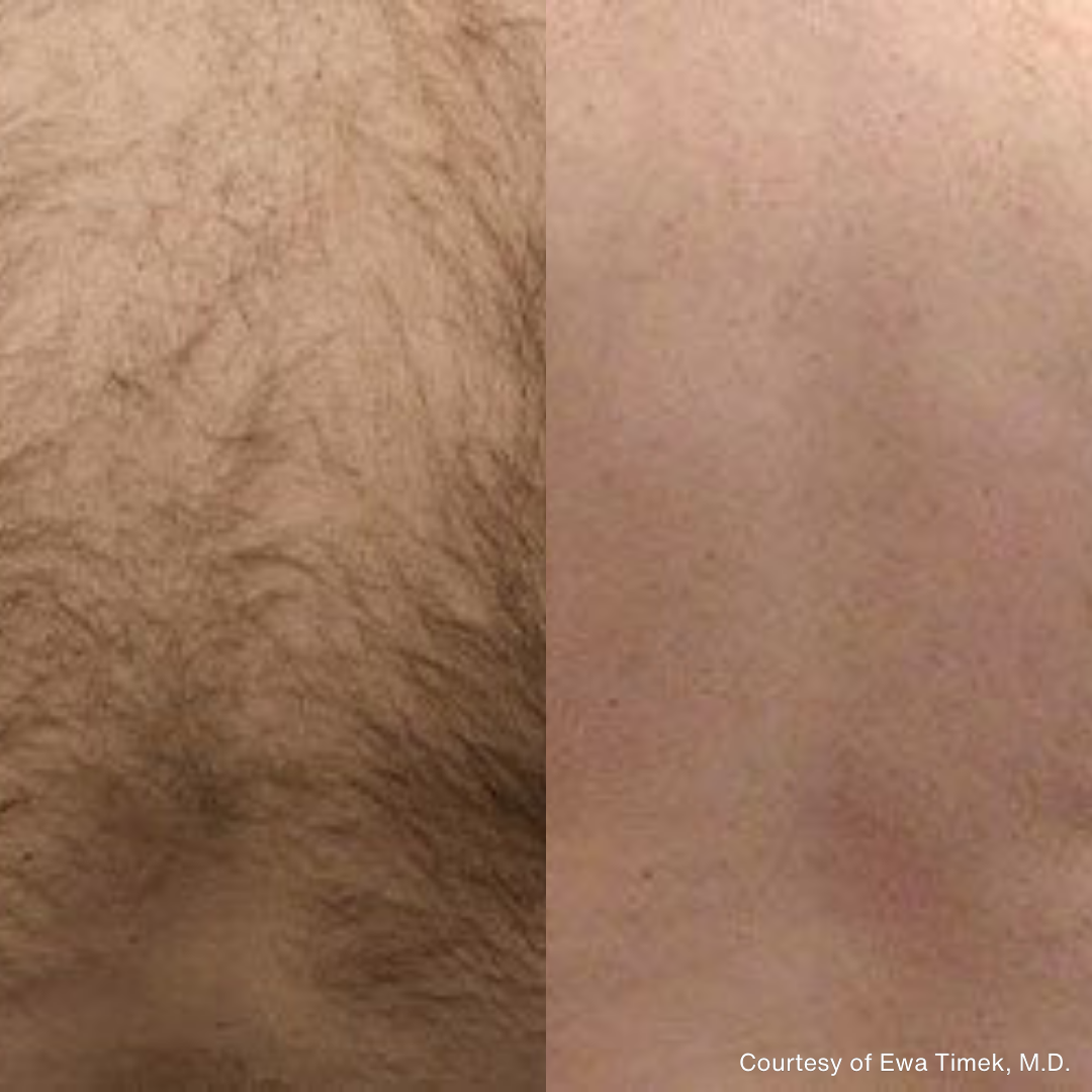 Hair reduction with the Rohrer Spectrum 810 nm diode. Representative Rohrer Aesthetics clinical image courtesy of Ewa Timek, M.D.; not a Juniper patient. Individual results vary.