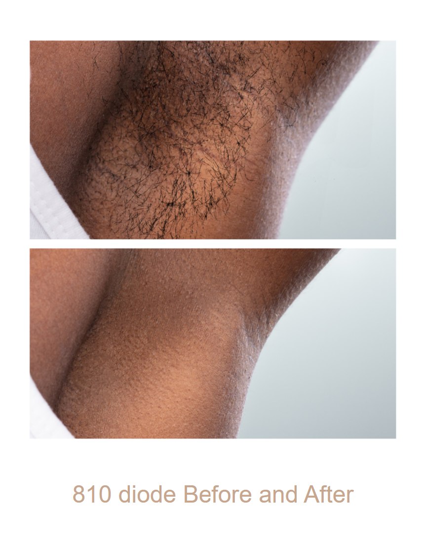 Underarm hair reduction with the Spectrum 810 nm diode. Representative manufacturer clinical image; not a Juniper patient. Individual results vary.