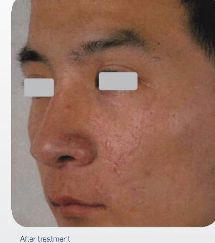 Scar Revision after treatment at Juniper Dermatology