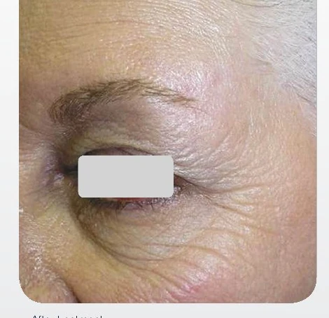 Scar Revision after treatment at Juniper Dermatology