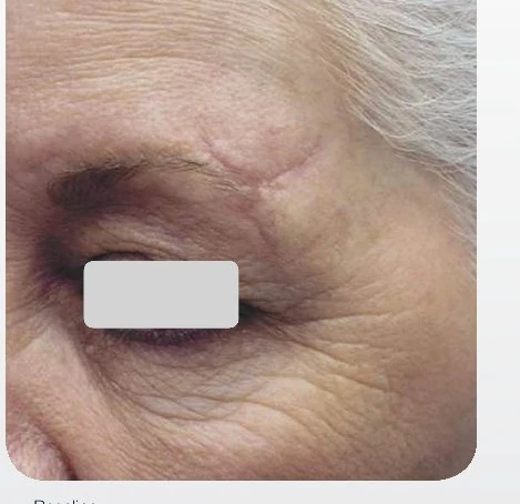 Scar Revision before treatment at Juniper Dermatology