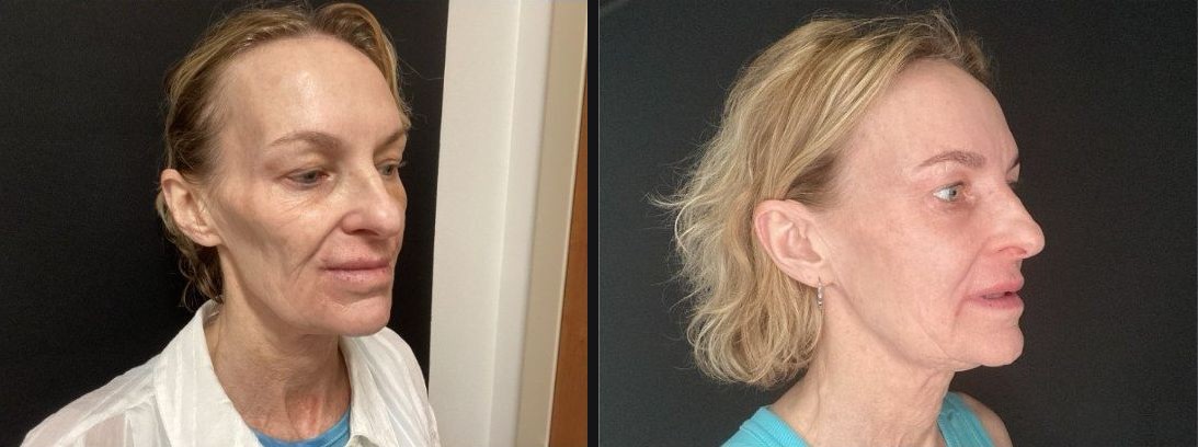 Three-quarter view — fuller cheeks and a refreshed contour after a Sculptra® series. Actual Juniper Dermatology patient; individual results vary.