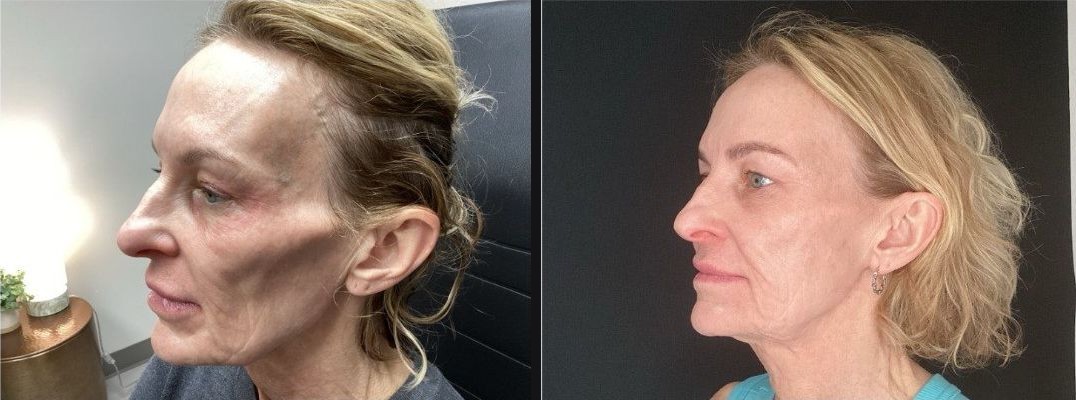 Profile — rebuilt volume through the cheek and jawline after a Sculptra® series. Actual Juniper Dermatology patient; individual results vary.