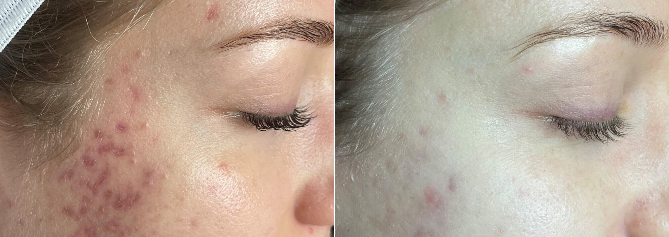 Acne marks & skin texture improved after microneedling. Representative manufacturer clinical image (SkinPen® Precision, Crown Aesthetics) — individual results vary.