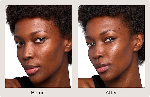 Smoother, more hydrated, luminous cheeks after SkinVive™. Representative clinical image (SkinVive™ by Juvéderm®) — individual results vary.