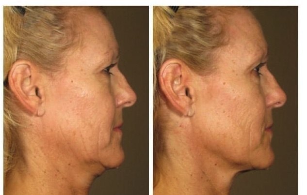 Firmer neck & jawline after Ultherapy®. Manufacturer clinical image — individual results vary.