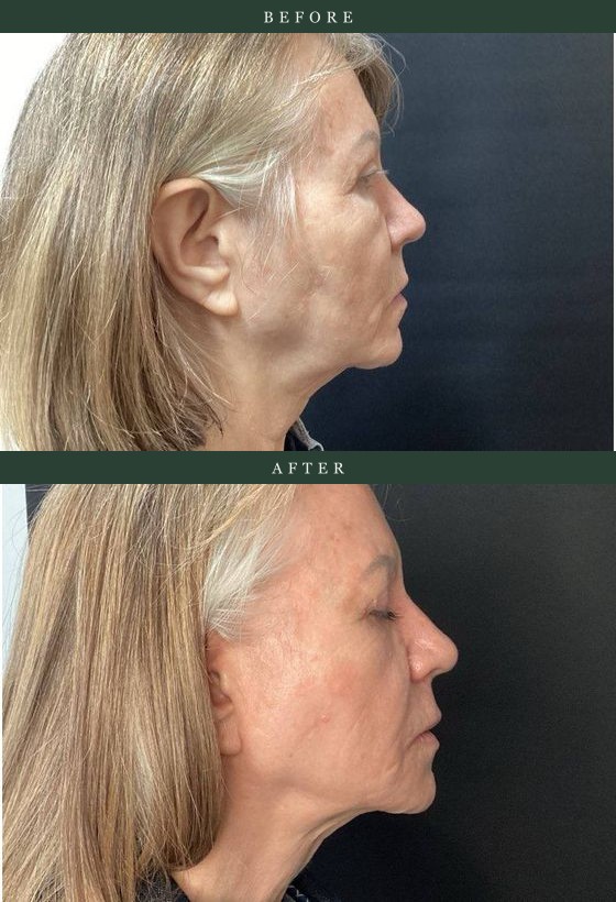 Firmer jawline & neck after Ultherapy® — actual Juniper patient. Individual results vary.