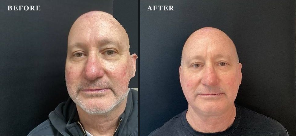 Facial redness & rosacea visibly calmed after VBeam® — actual Juniper Dermatology patient. Individual results vary.