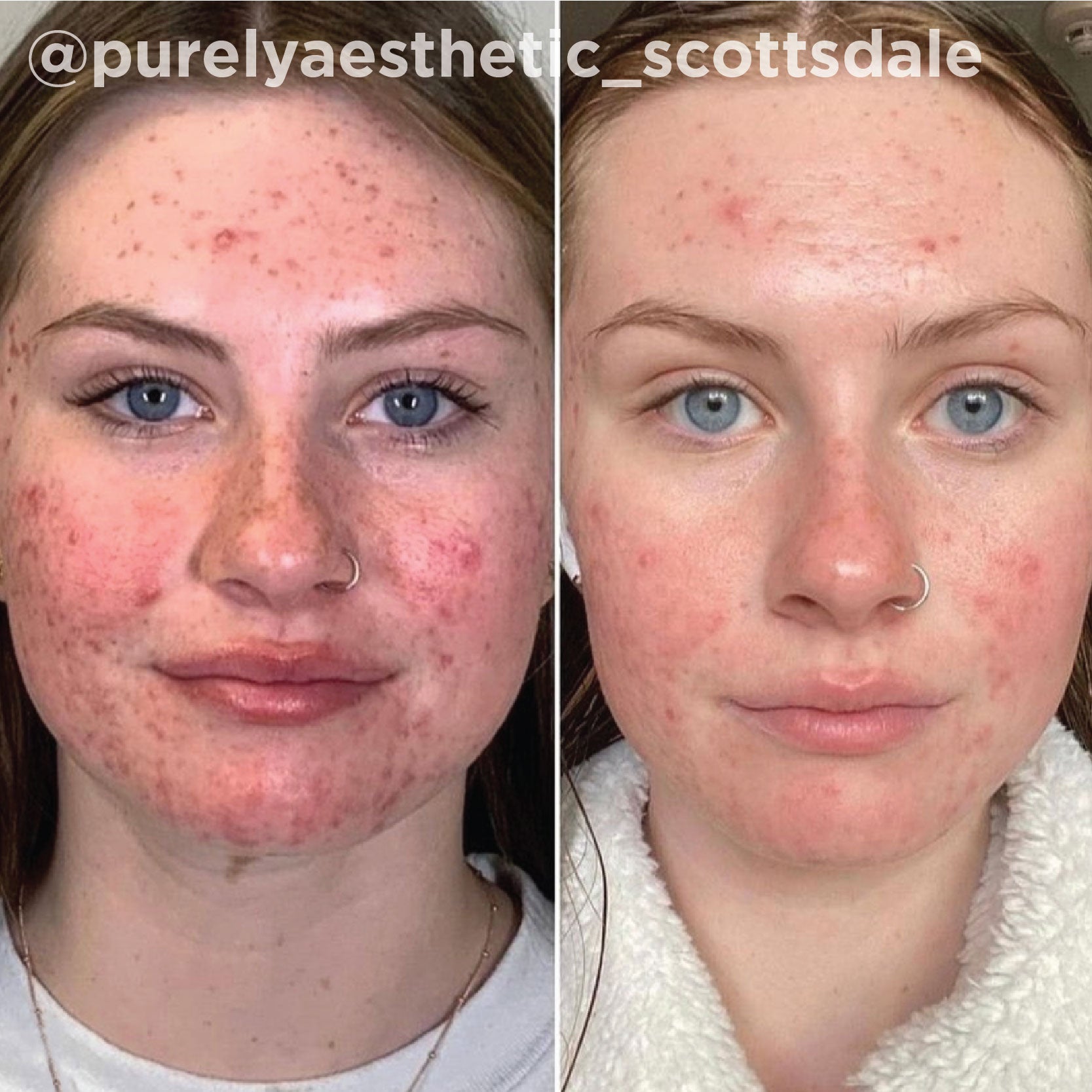 Post-acne marks, redness and congestion cleared after a series of VI Peel® treatments. Representative manufacturer clinical case (VI Peel® by the Vitality Institute); not a Juniper patient. Individual results vary.