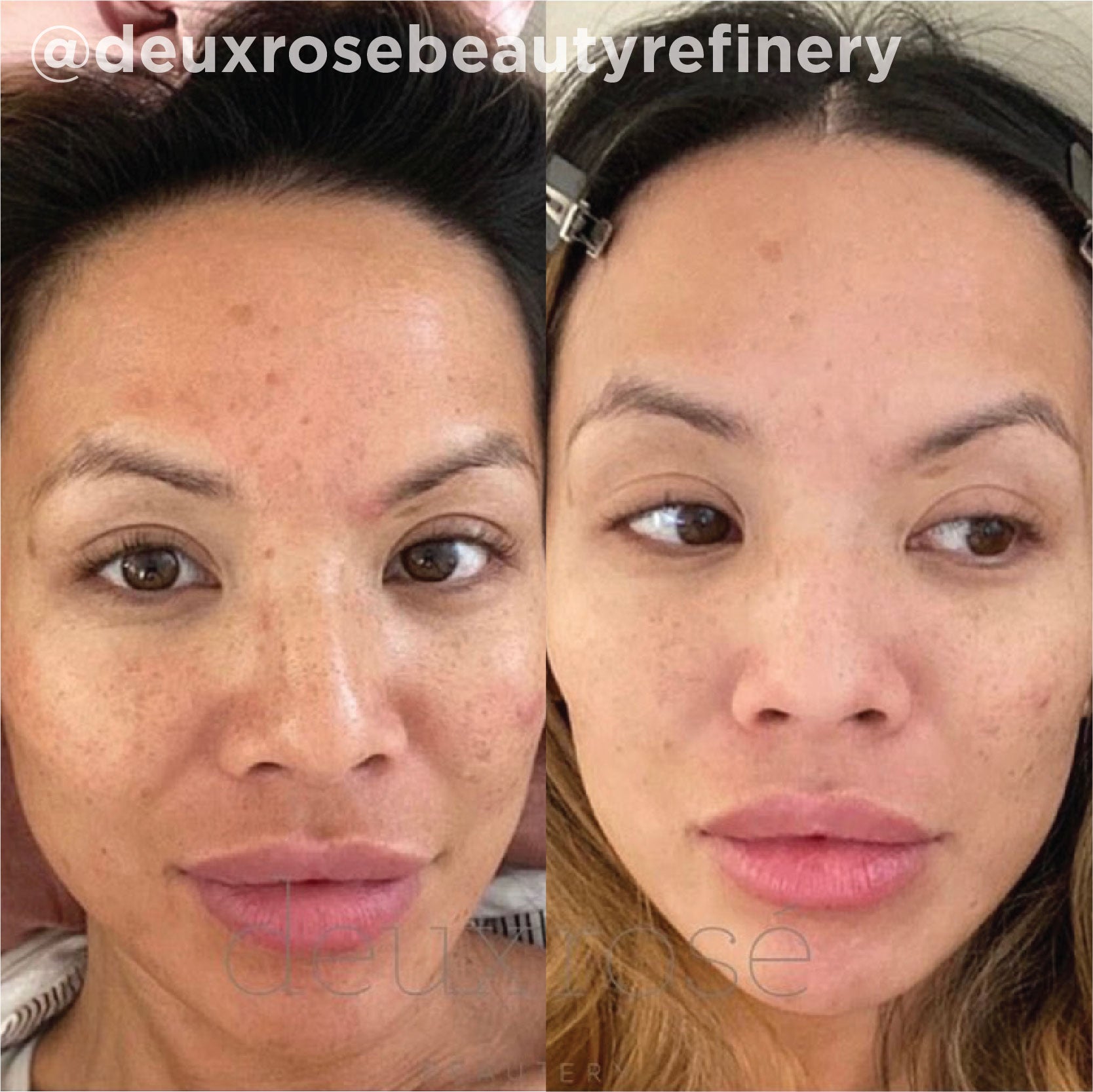 Sun-induced pigmentation and uneven tone improved after a series of VI Peel® treatments. Representative manufacturer clinical case (VI Peel® by the Vitality Institute); not a Juniper patient. Individual results vary.