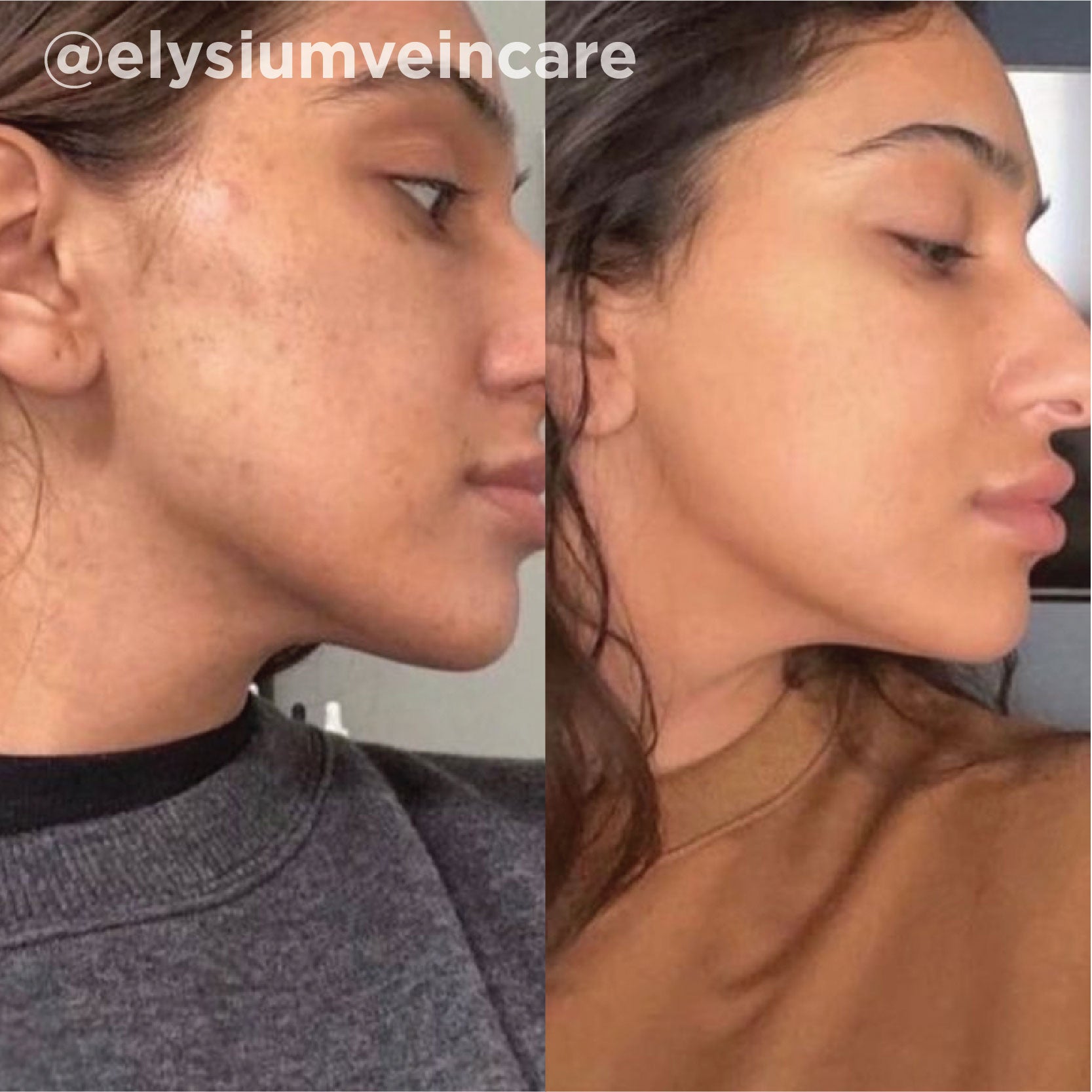 Rough texture and congestion refined after a series of VI Peel® treatments. Representative manufacturer clinical case (VI Peel® by the Vitality Institute); not a Juniper patient. Individual results vary.