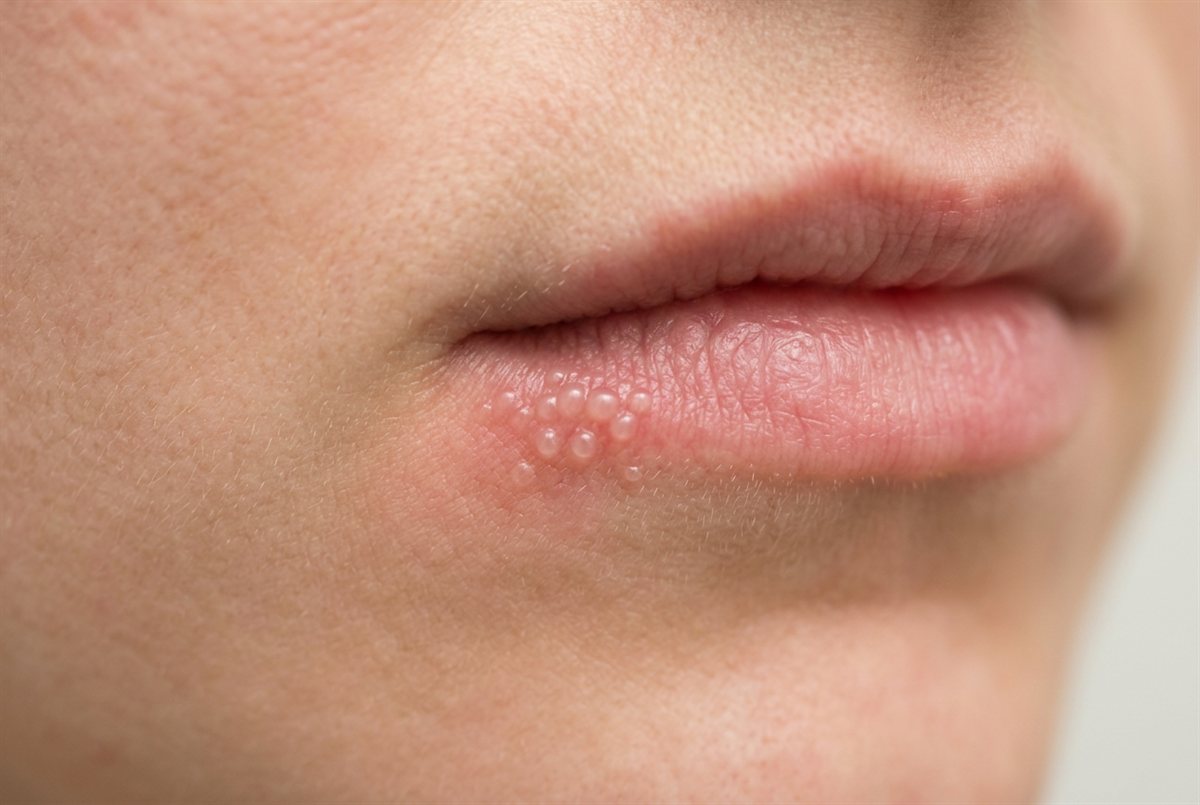 Representative clinical image of a cold sore — a small cluster of blisters at the edge of the lip