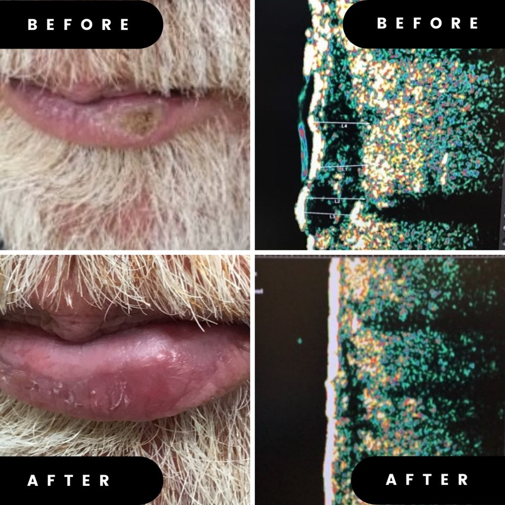 Before and after GentleCure treatment of a lip skin cancer lesion at Juniper Dermatology
