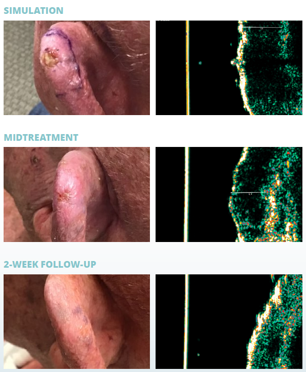 Ear skin cancer treatment progress — simulation, mid-treatment, and 2-week follow-up at Juniper Dermatology