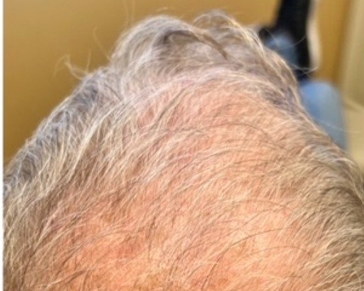 Hair loss before treatment - Men's thinning - crown, Juniper Dermatology