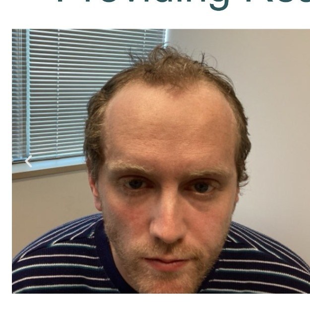 Hair loss before treatment - Men's thinning - frontal hairline, Juniper Dermatology