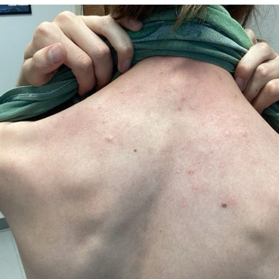 Acne after treatment at Juniper Dermatology