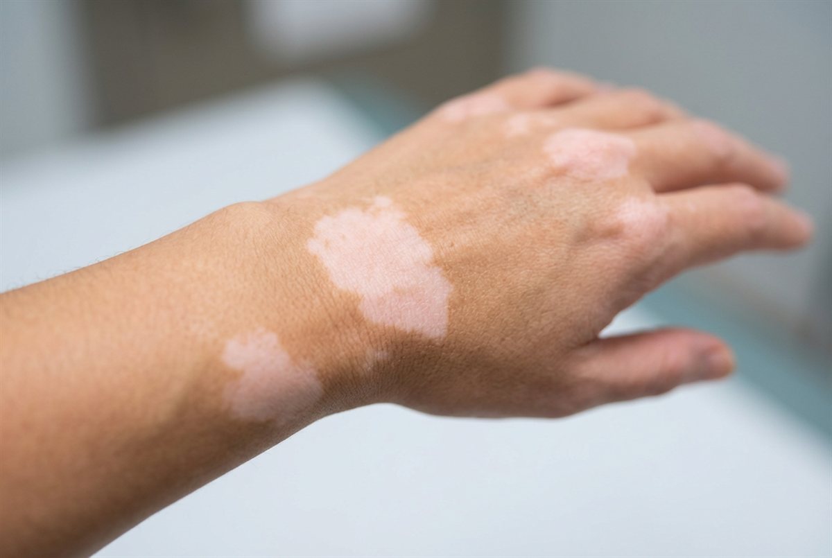 Representative clinical image of vitiligo — smooth, well-defined patches of lighter, depigmented skin on the hand and wrist