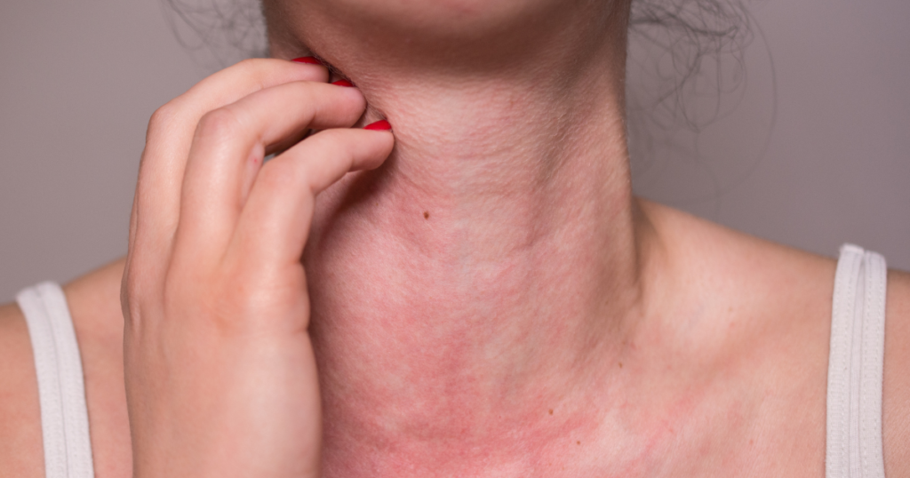 Someone with irritated skin on their neck.