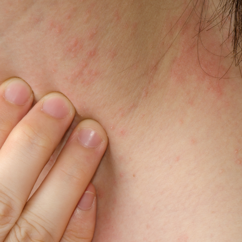 Patient before eczema treatment at Juniper Dermatology in Bend, Oregon