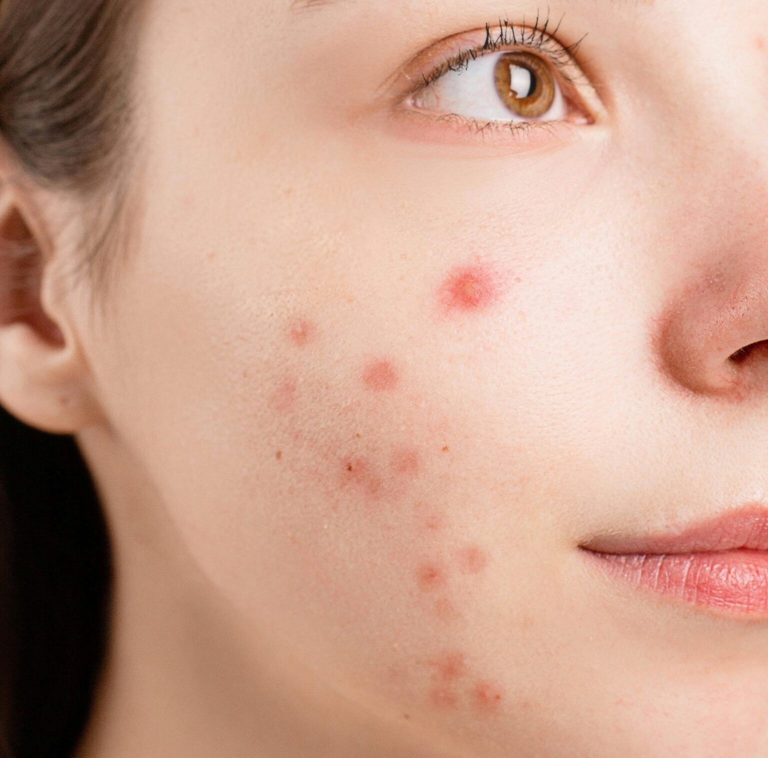 Patient before receiving acne treatment at Juniper Dermatology in Bend, OR