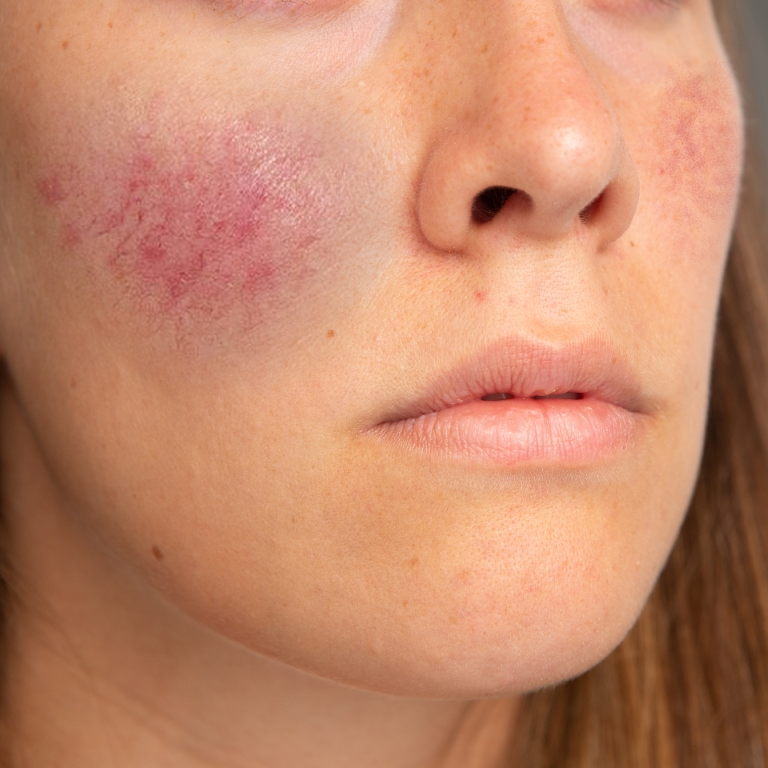 woman before rosacea treatment at Juniper Dermatology in Bend, OR