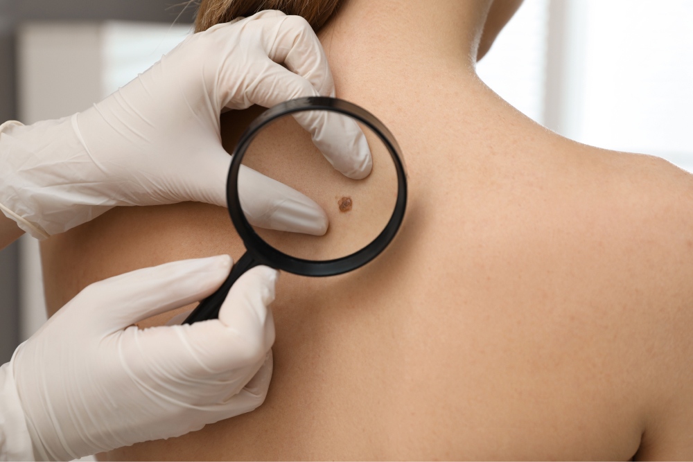 Melanoma and Skin Cancer Treatment in Bend, OR