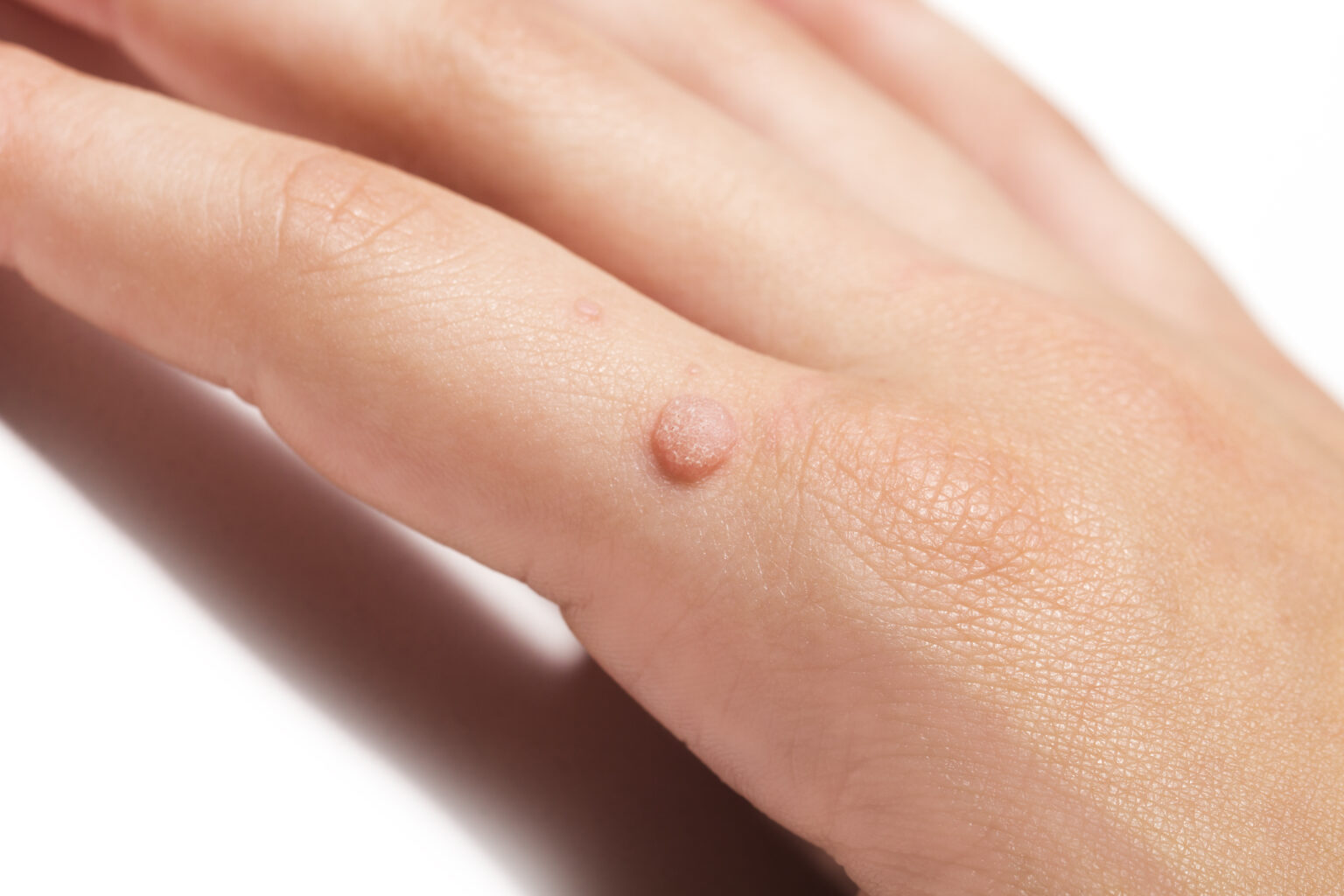 Patient before wart removal at Juniper Dermatology in Bend, OR