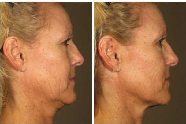 juniper-ulthera-ultrapulse