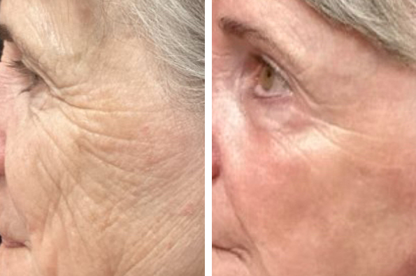 Patient before and after CO2 laser in bend, OR