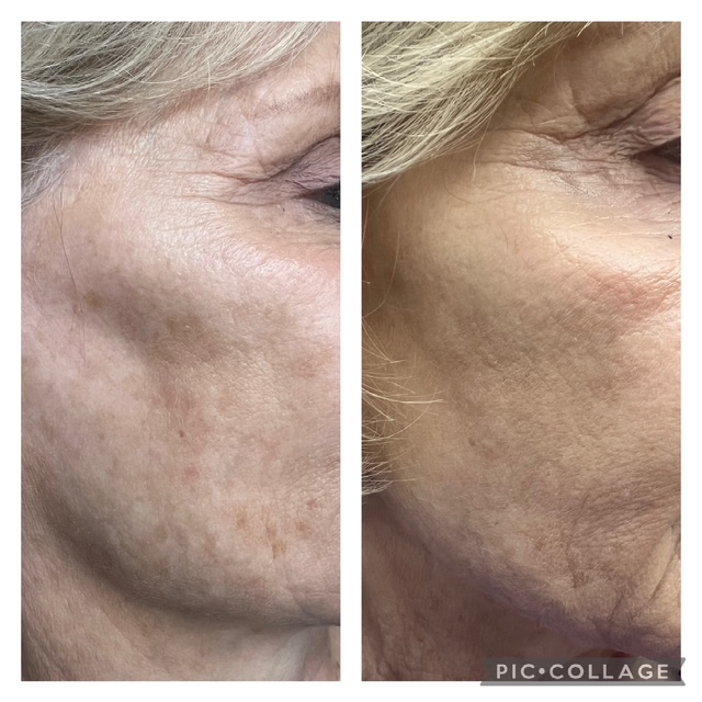 Before and after radiesse treatment in Bend, OR