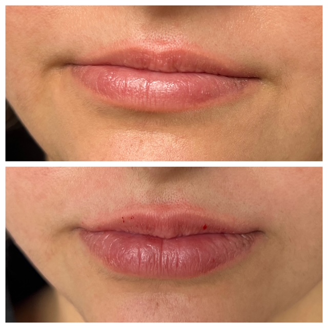 Before and after lip filler in bend, or