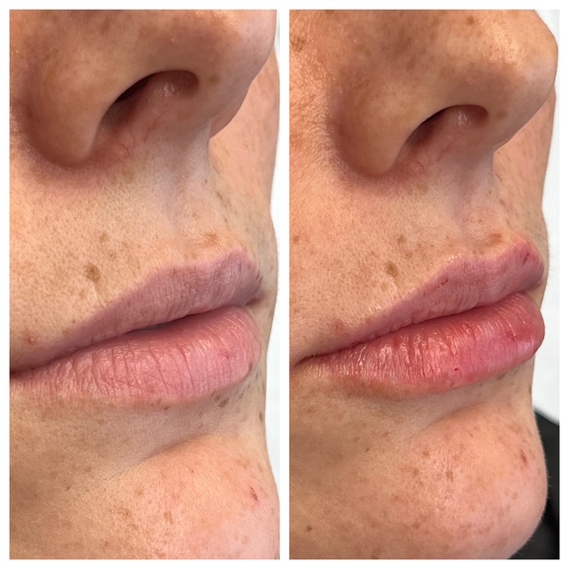 Before and after lip filler in Bend, OR