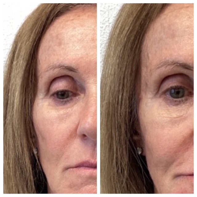Before and after RHA fillers in Bend, OR