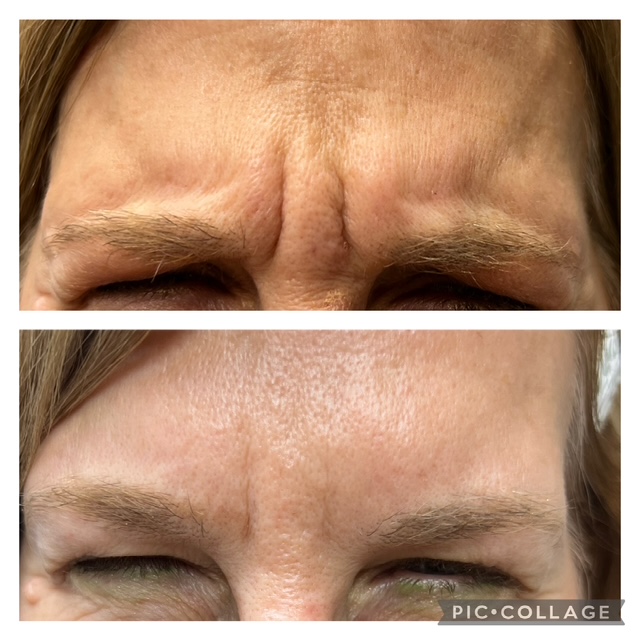 Before and after botox for wrinkles in Bend