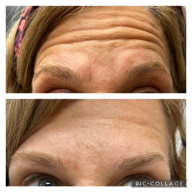 Before and after botox for wrinkles in Bend