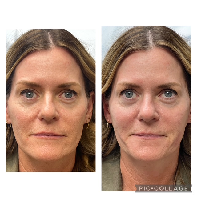 Before and after sculptra in Bend, OR