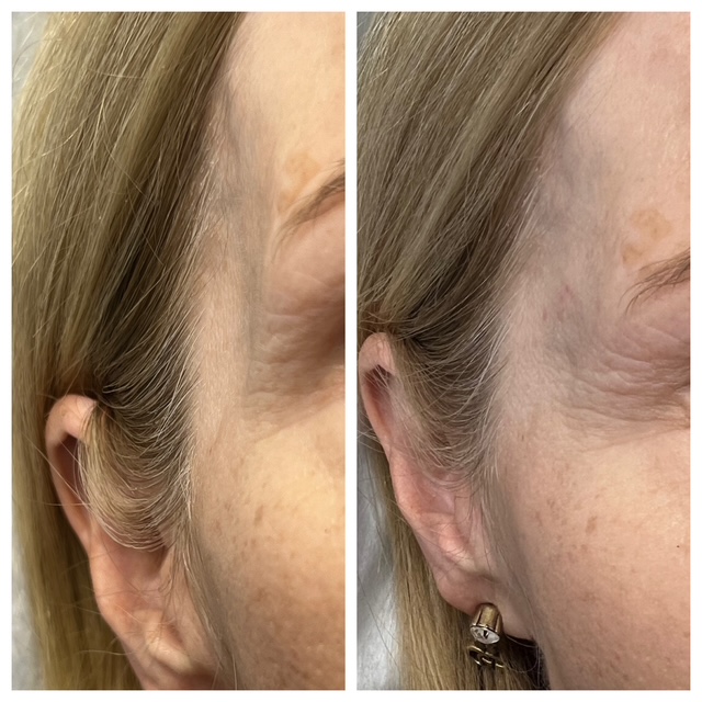 Before and after temple filler in bend, or