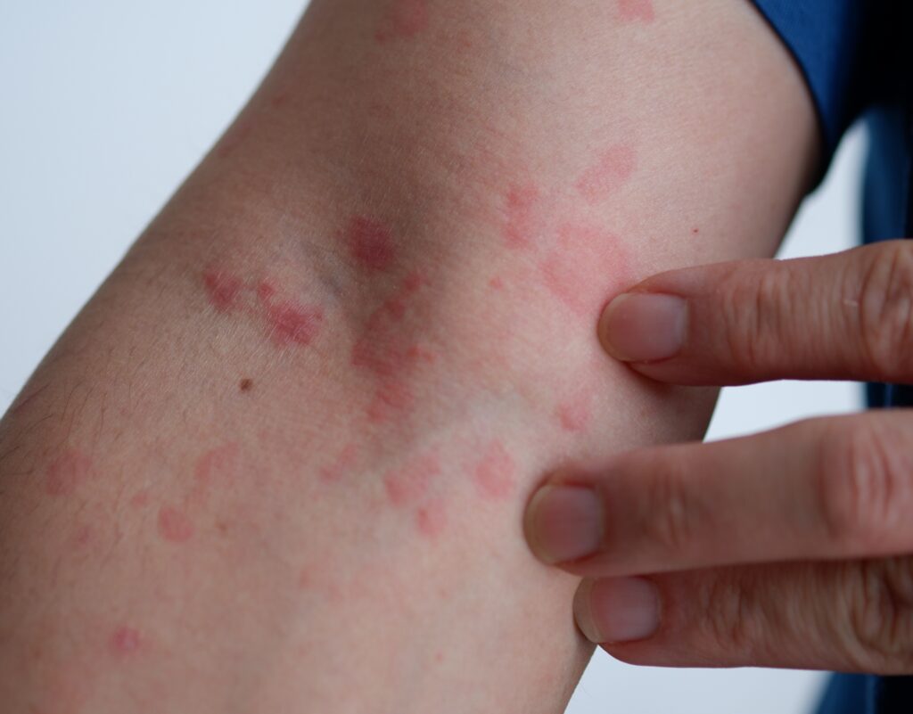 patient before and after hives treatment in bend, or